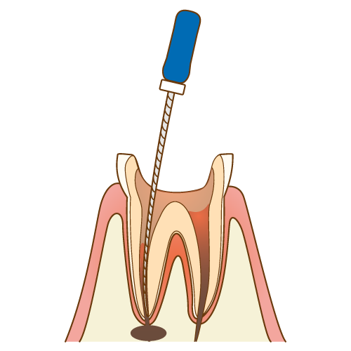 根管治療は神経がないのになぜ痛い？