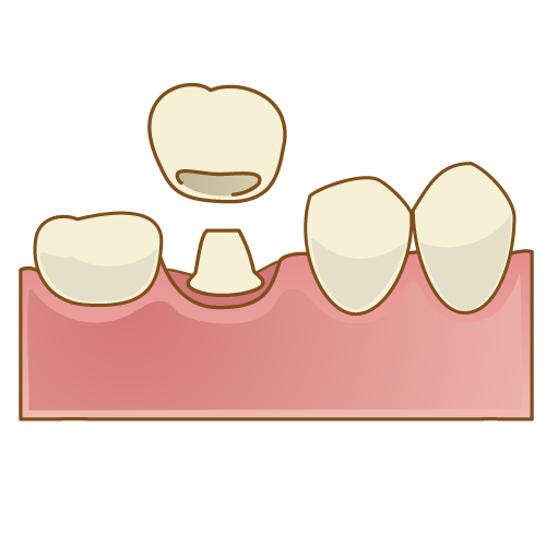 歯を残すため治療 根管治療 希望ヶ丘の歯科 あおみ歯科