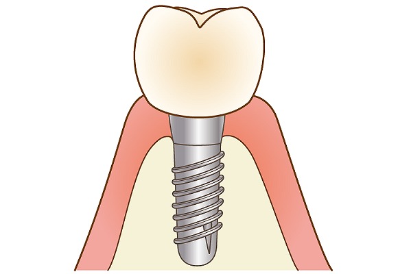 インプラント
