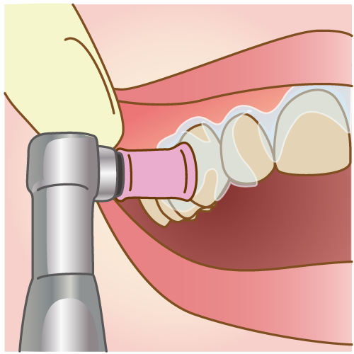 歯のクリーニング
